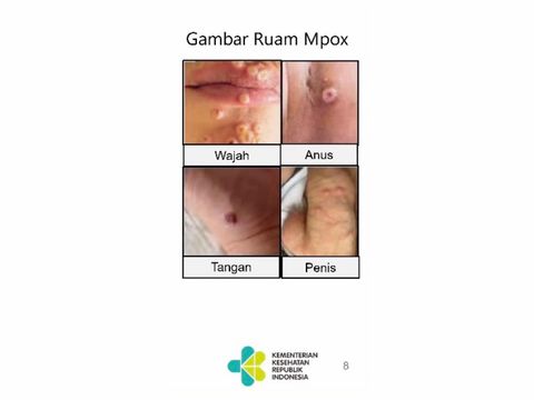 Cacar Monyet Mematikan, Jumlah Kasus di Indonesia Naik Terus