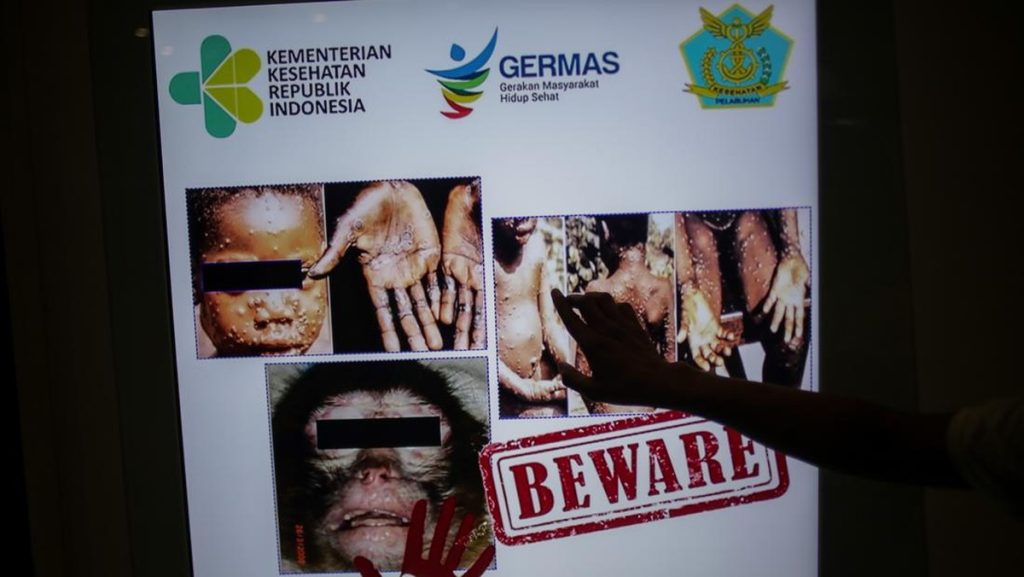 Gejala & Penularan Cacar Monyet yang Sudah Masuk Indonesia