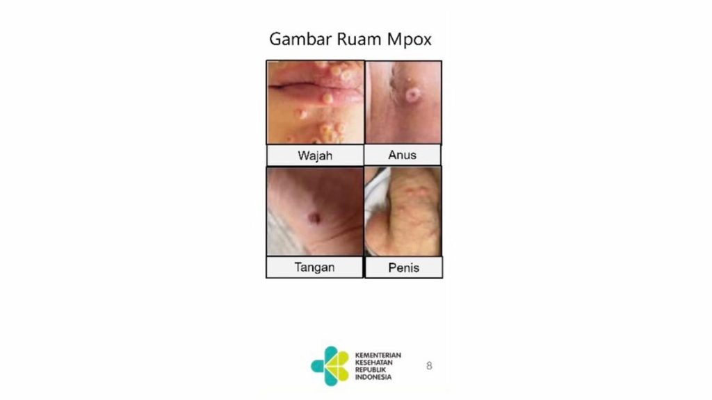 Ini Biang Kerok Kasus Cacar Monyet di Indonesia Naik Tinggi