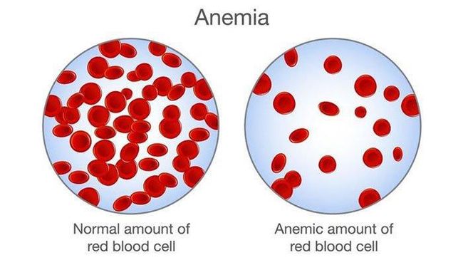 Kasusnya Langka Ditemukan, Ini Gejala-Pencegahan Anemia Aplastik