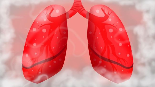 Bukan Cuma Rokok, Ini 5 Daftar Pemicu Kanker Paru-Paru Usia Muda