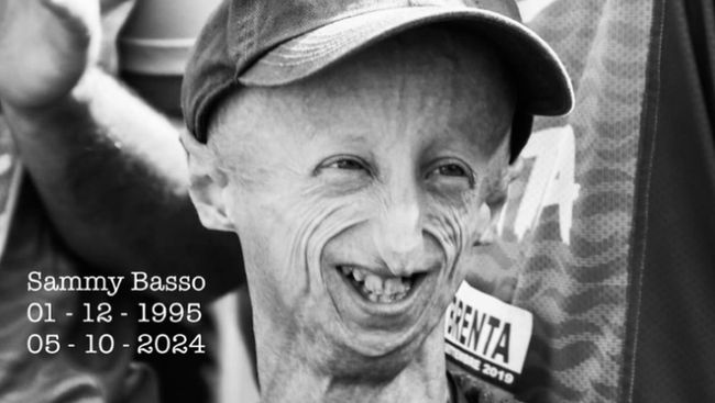Mengenal Progeria, Penyakit yang Bikin Sammy Basso Alami Penuaan Dini